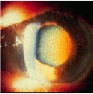 eye disease cataracts pics